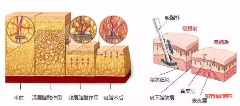 吸脂减肥